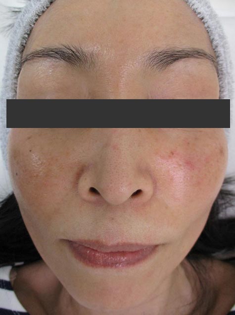 レーザー治療症例 治療前